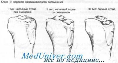 Гипсовая повязка и вытяжение